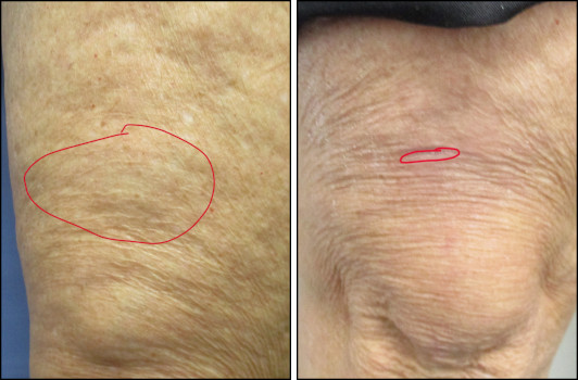 Chicago mole removal shave no scarring
